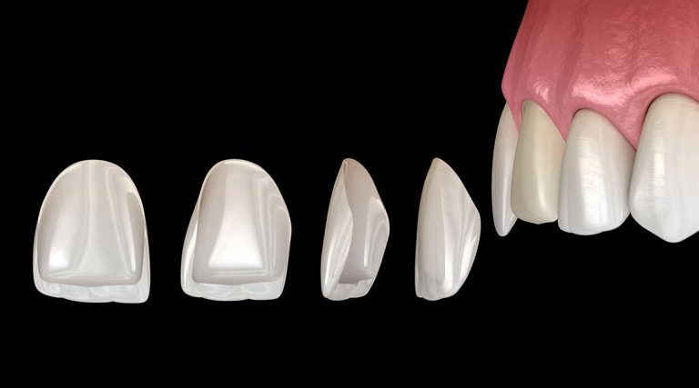 Lamine Kaplama 6 lamine porselen tedavisi